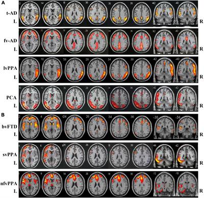 Early-stage differentiation between Alzheimer’s disease and frontotemporal lobe degeneration: Clinical, neuropsychology, and neuroimaging features